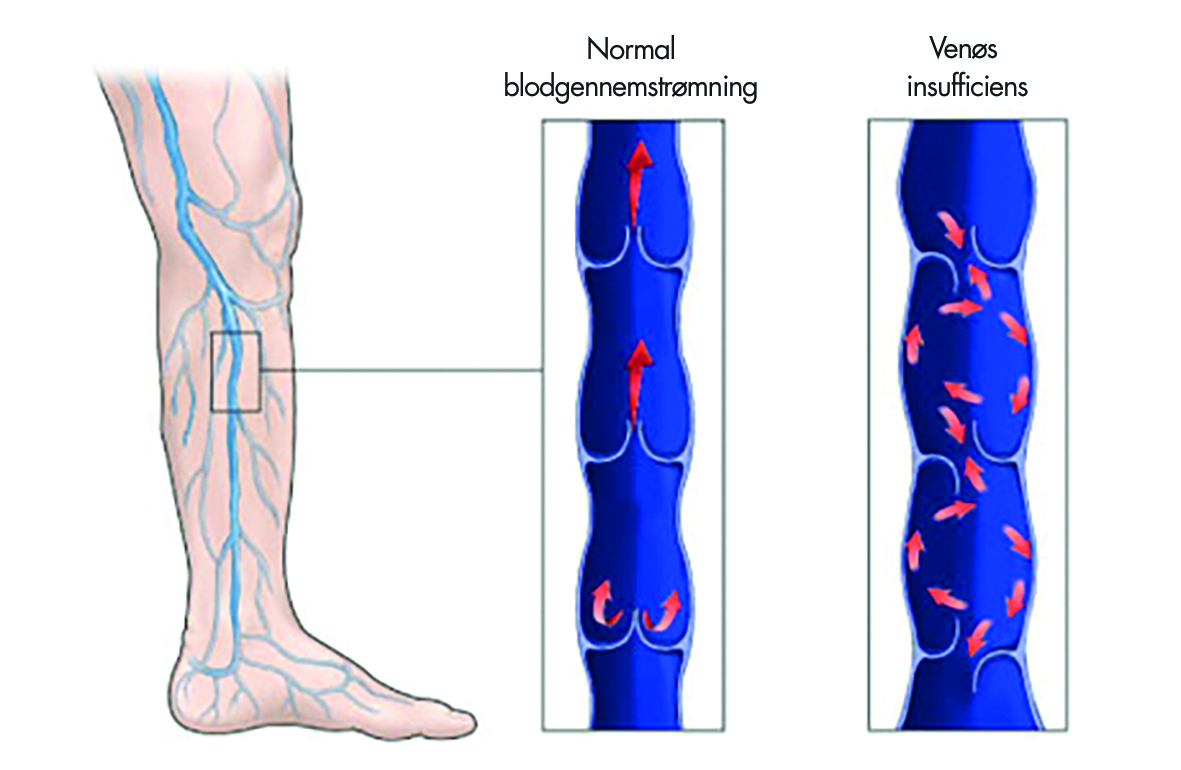 Тромбоз артерия и вена. Варикозное расширение вен нижних конечностей ХВН. Хроническая венозная недостаточность (ХВН). Venoznaya-nedostatochnost-nizhnikh-konechnostey. Тромбоз суральной вены голени.